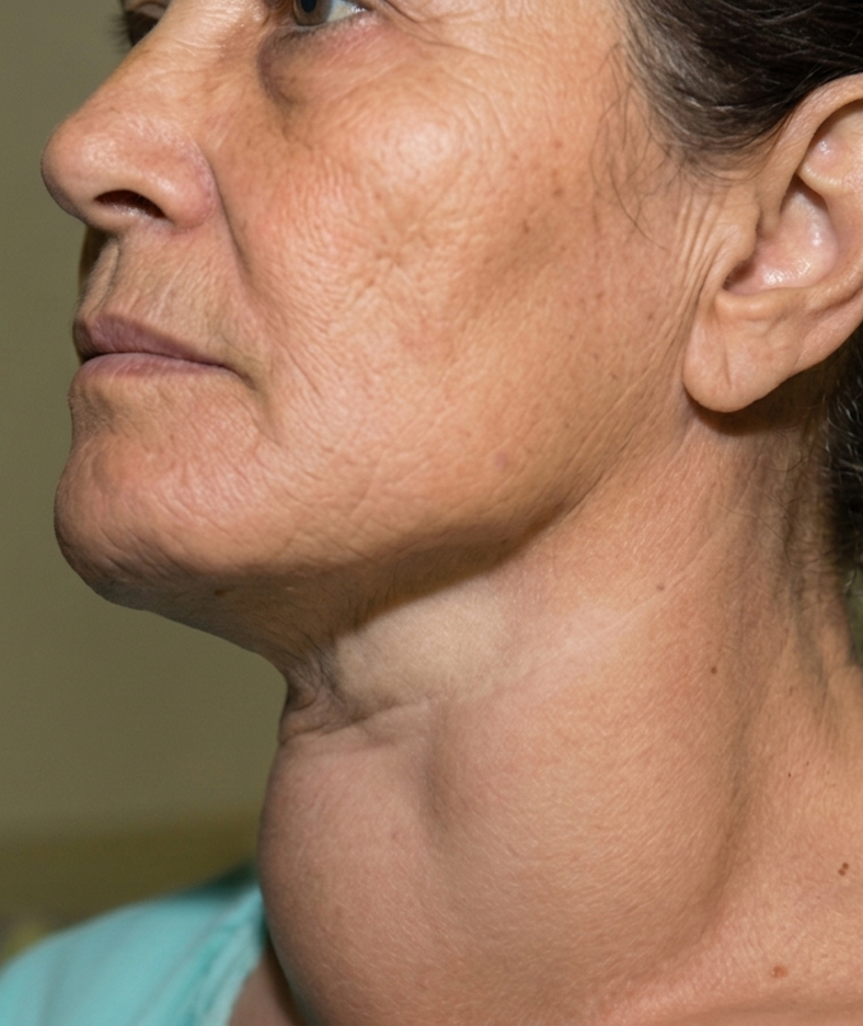 thyroid nodules 